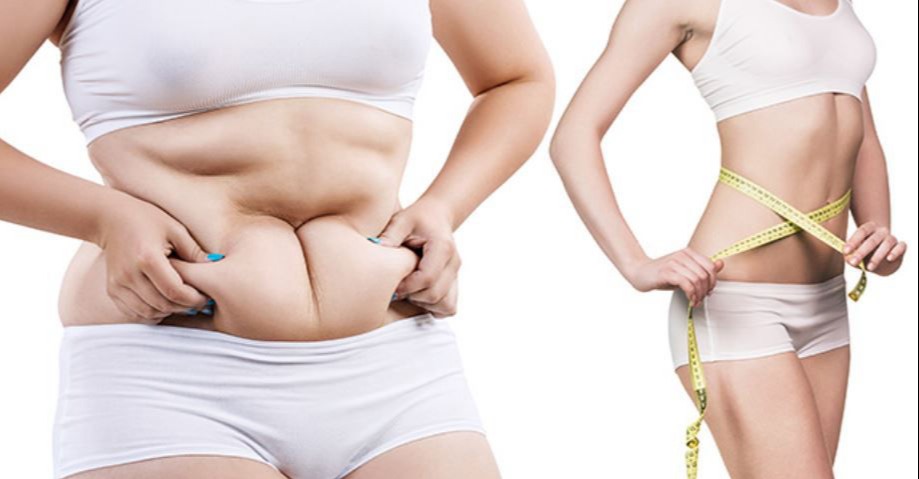 abdominoplasty recover