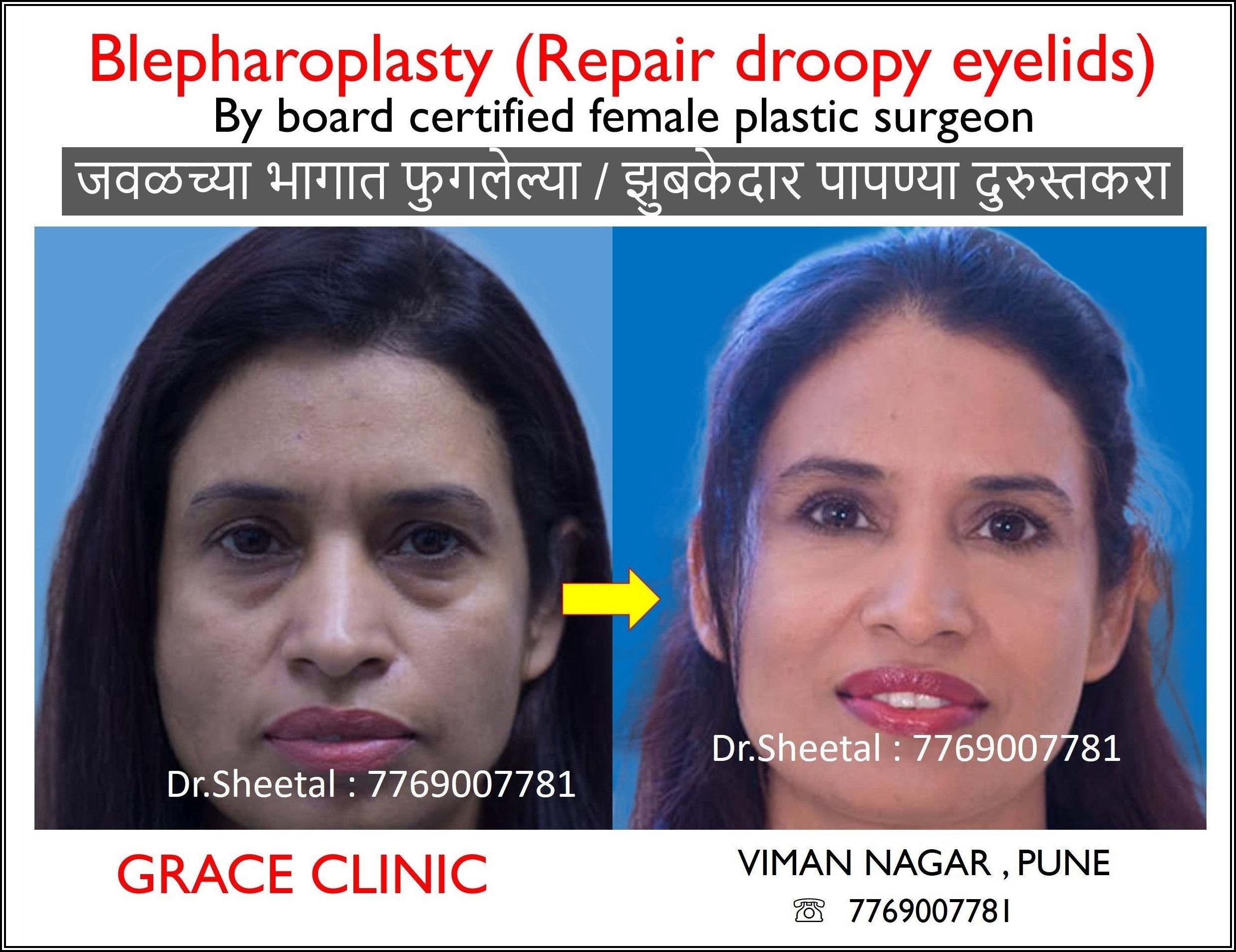blepharoplasty soggy eye , droopy eyelids treatment