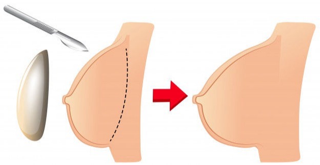 Breast augmentation , breast enlargement , breast size increase , surgery cost pune
