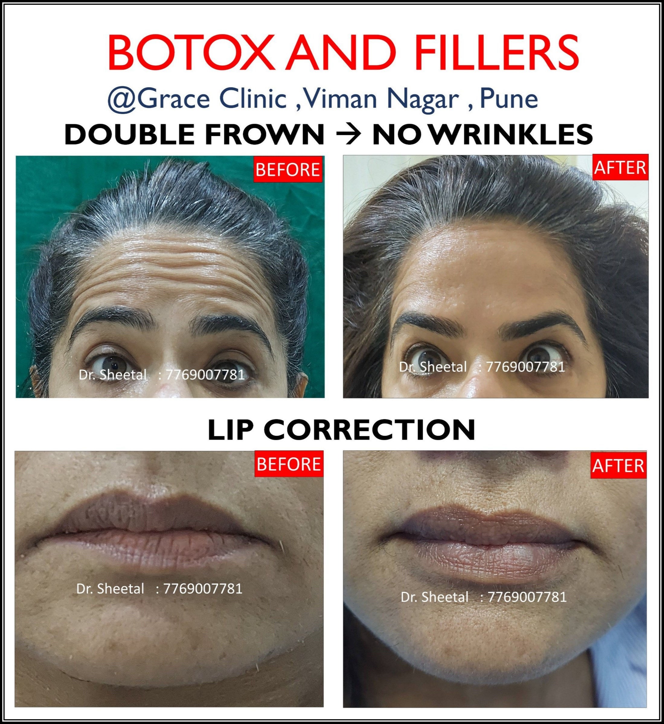 botox fillers guaranteed results and cost Pune