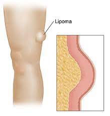lipoma surgery Pune