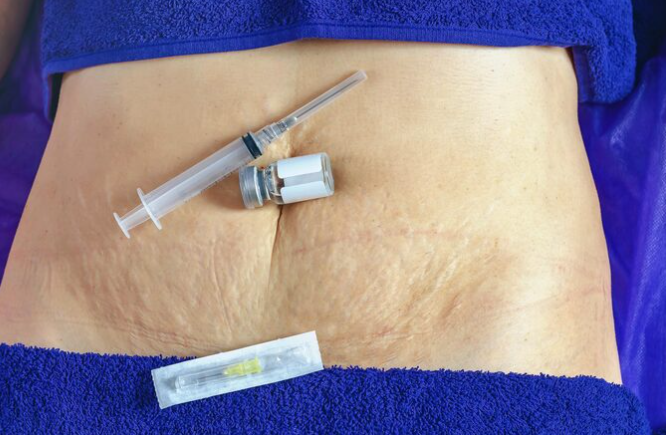 Loose Skin Removal Surgery